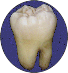 Extracted wisdom tooth